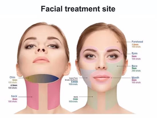 Máquina 4D Hifu 20.000 tiros Face Lift para emagrecimento corporal