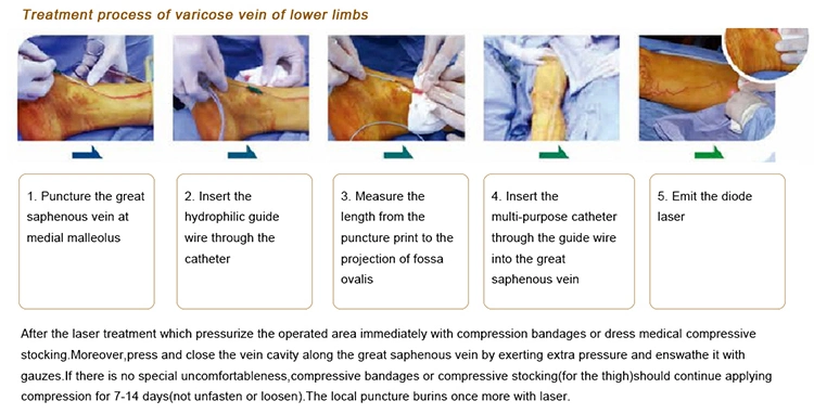 980nm 1470nm Diode Laser Endovenous Vein Treatment Laser/ Vascular Removal Laser Endovenous Laser Ablation Medical Equipment