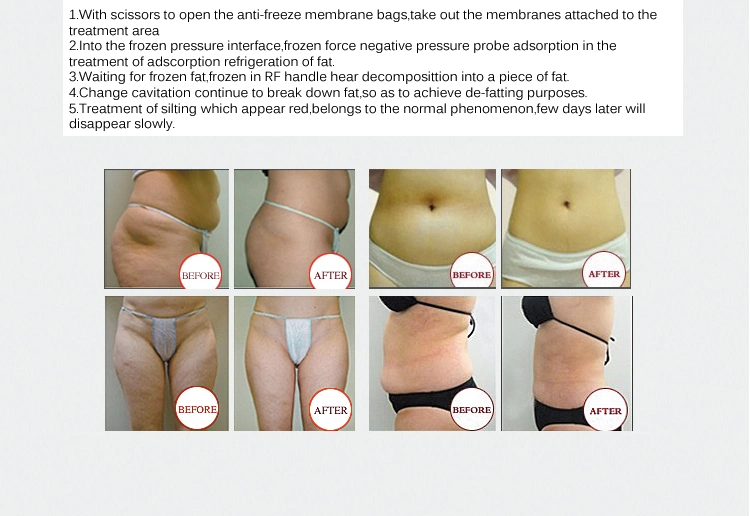 Multifunction Cryo Cavitation RF Vertical 5 Handles Cool Body Sculpting Cryolipolysis Fat Freezing Slimming