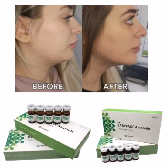 Hot Portable Hifu Ultrashape Vertical Emagrecimento Perda De Peso Liposonix