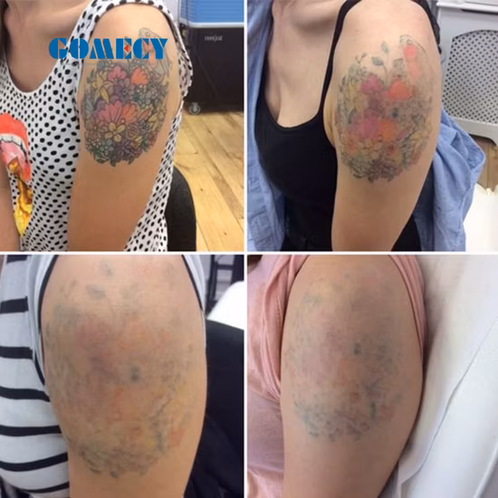 Peeling de carbono portátil para remoção de tatuagem a laser ND YAG de picossegundos