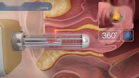 Tubo de RF de Metal Remoção de Estrias Aperto Vaginal Laser de CO2 Fracionado Laser de CO2 Fracionado Aperto Vaginal Rejuvenescimento da Pele Laser de CO2 Fracionado